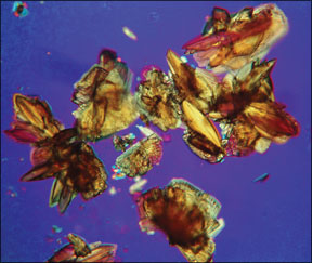 Uric acid crystals