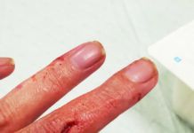 dog bite on hand - what to do when a dog bites you