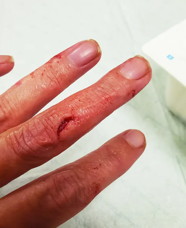 dog bite on hand - what to do when a dog bites you