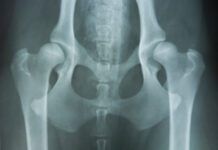 hip dysplasia