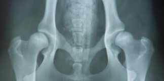 hip dysplasia