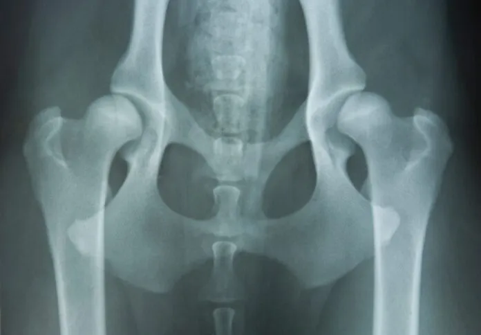 hip-dysplasia hip dysplasia