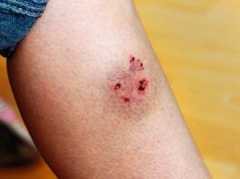 Woman's leg injured by a dog bite