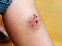Woman's leg injured by a dog bite